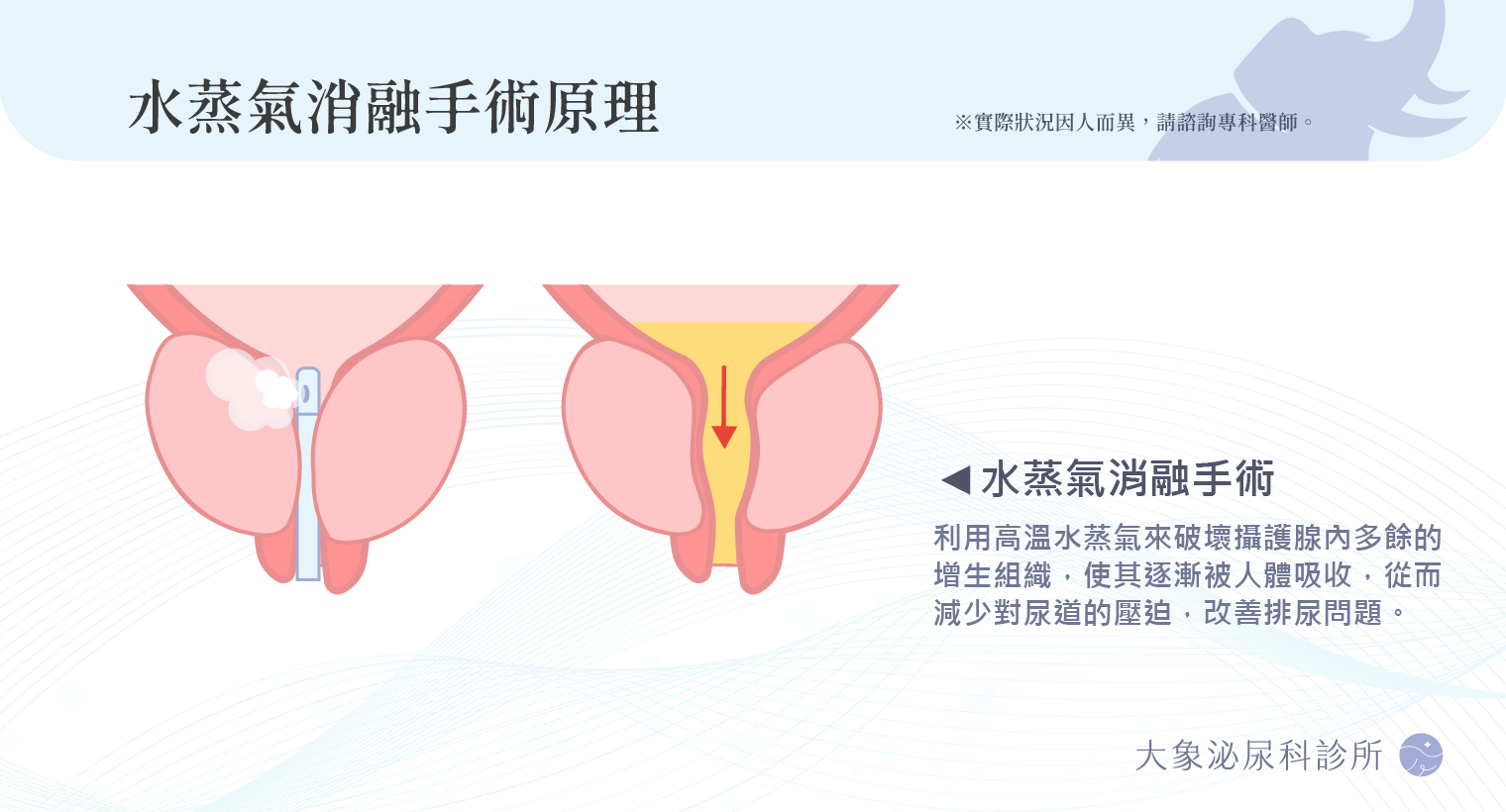 桃園 中壢/泌尿科/大象 - 水蒸氣消融術