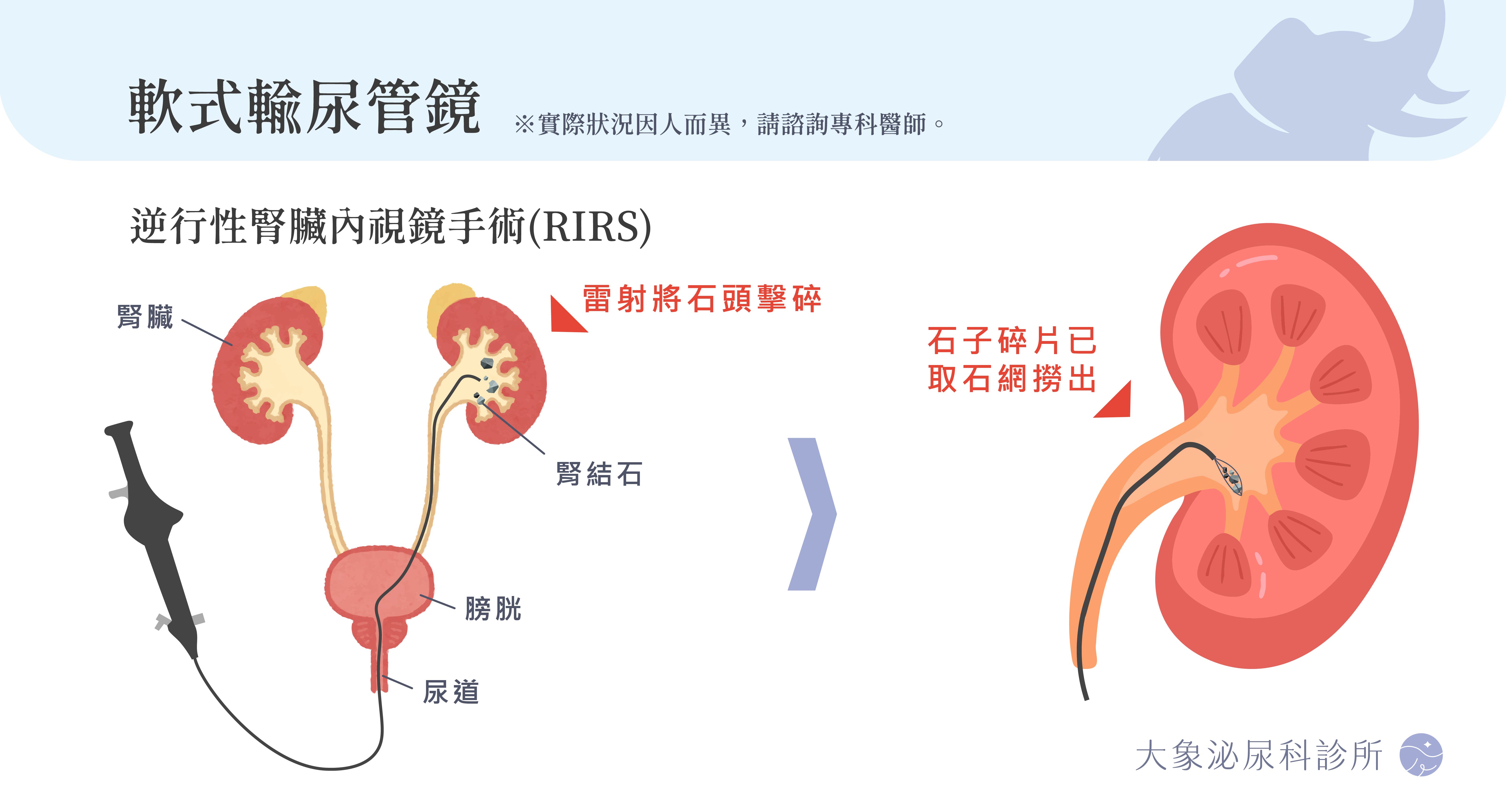 桃園 中壢/泌尿科/大象 - 軟式輸尿管鏡