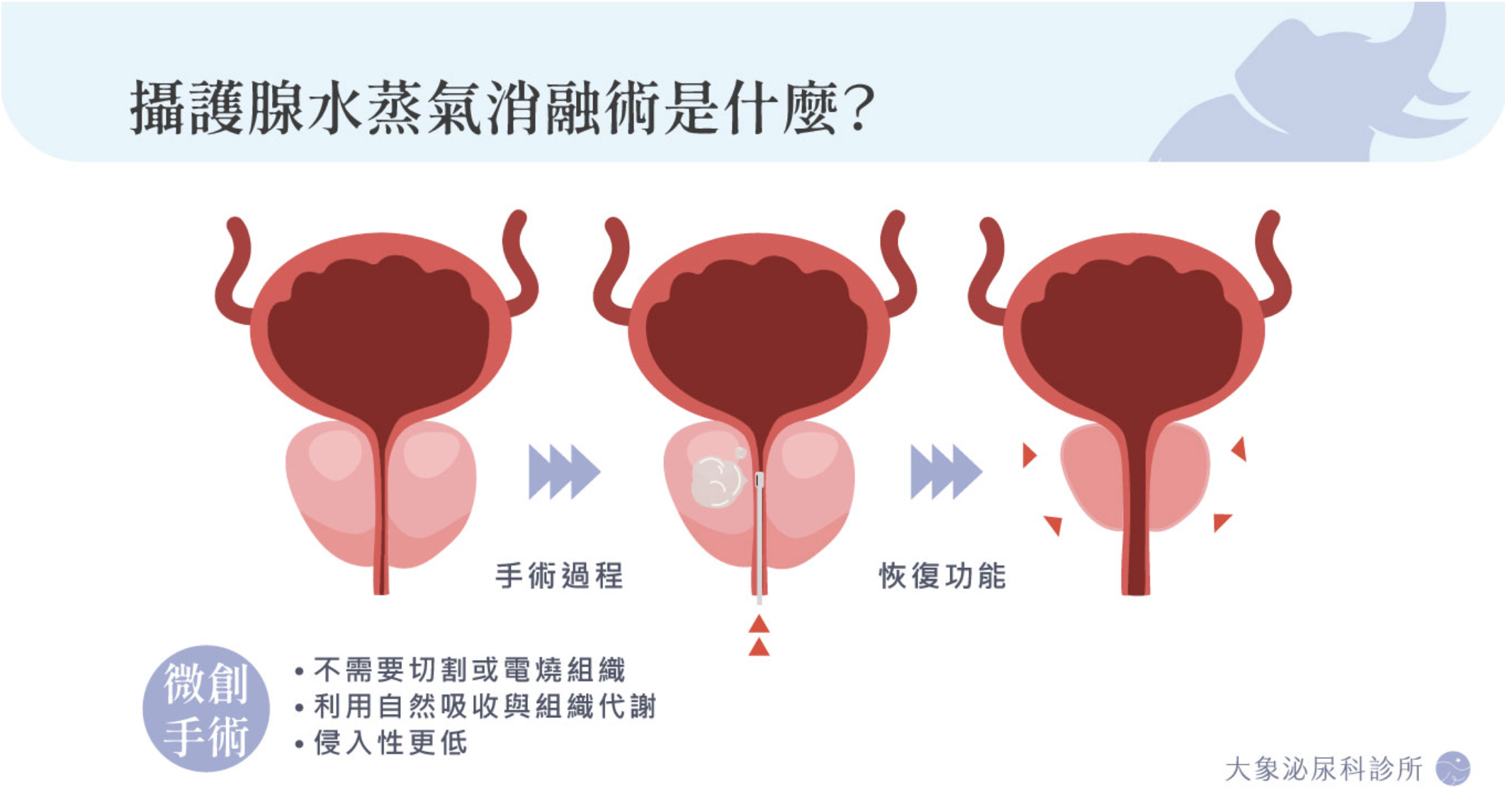桃園 中壢/泌尿科/大象 - 攝護腺水蒸氣消融術完整解析：有效嗎？費用、恢復期、適合對象與副作用