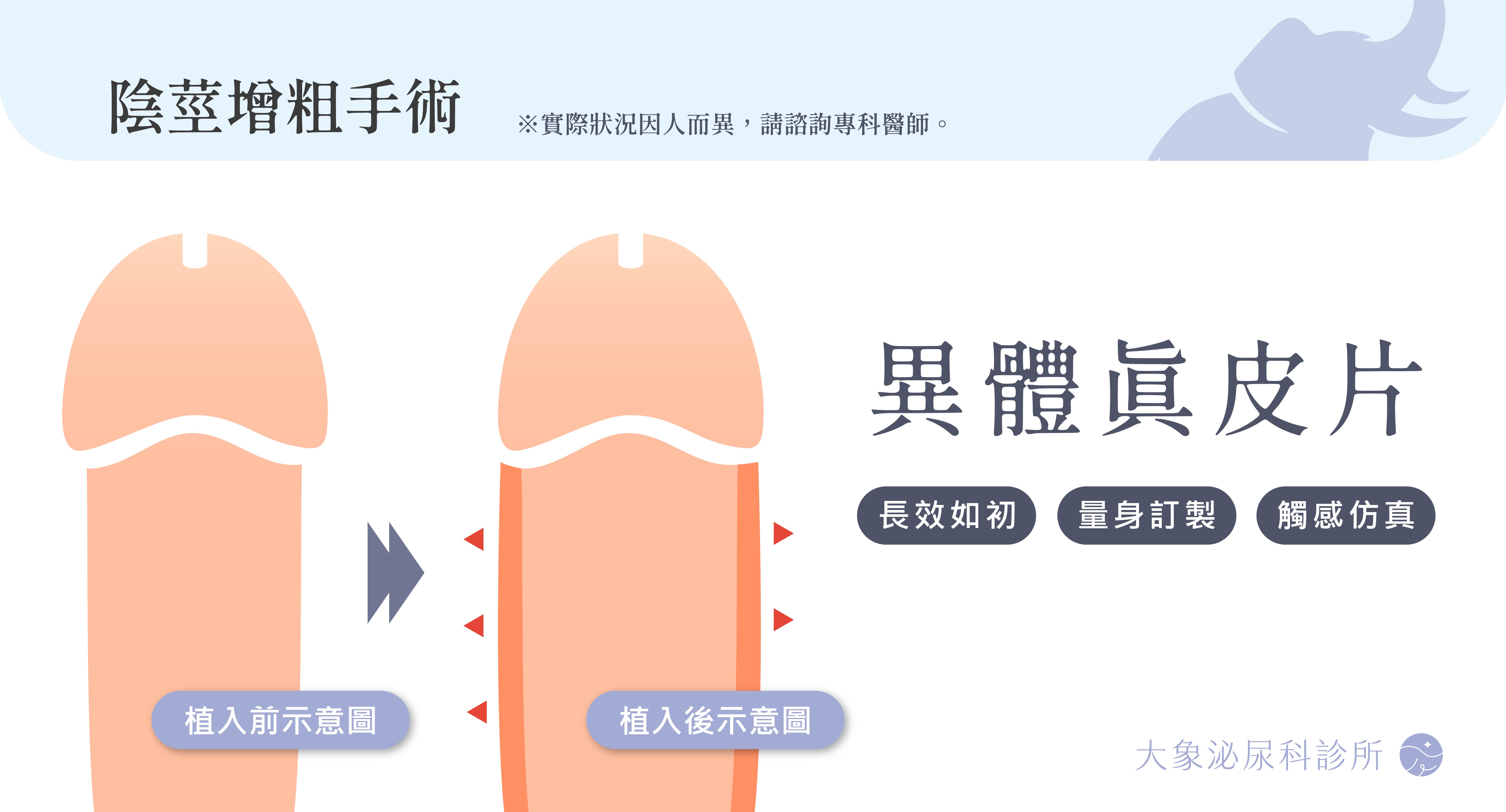 桃園 中壢/泌尿科/大象 - 陰莖增粗