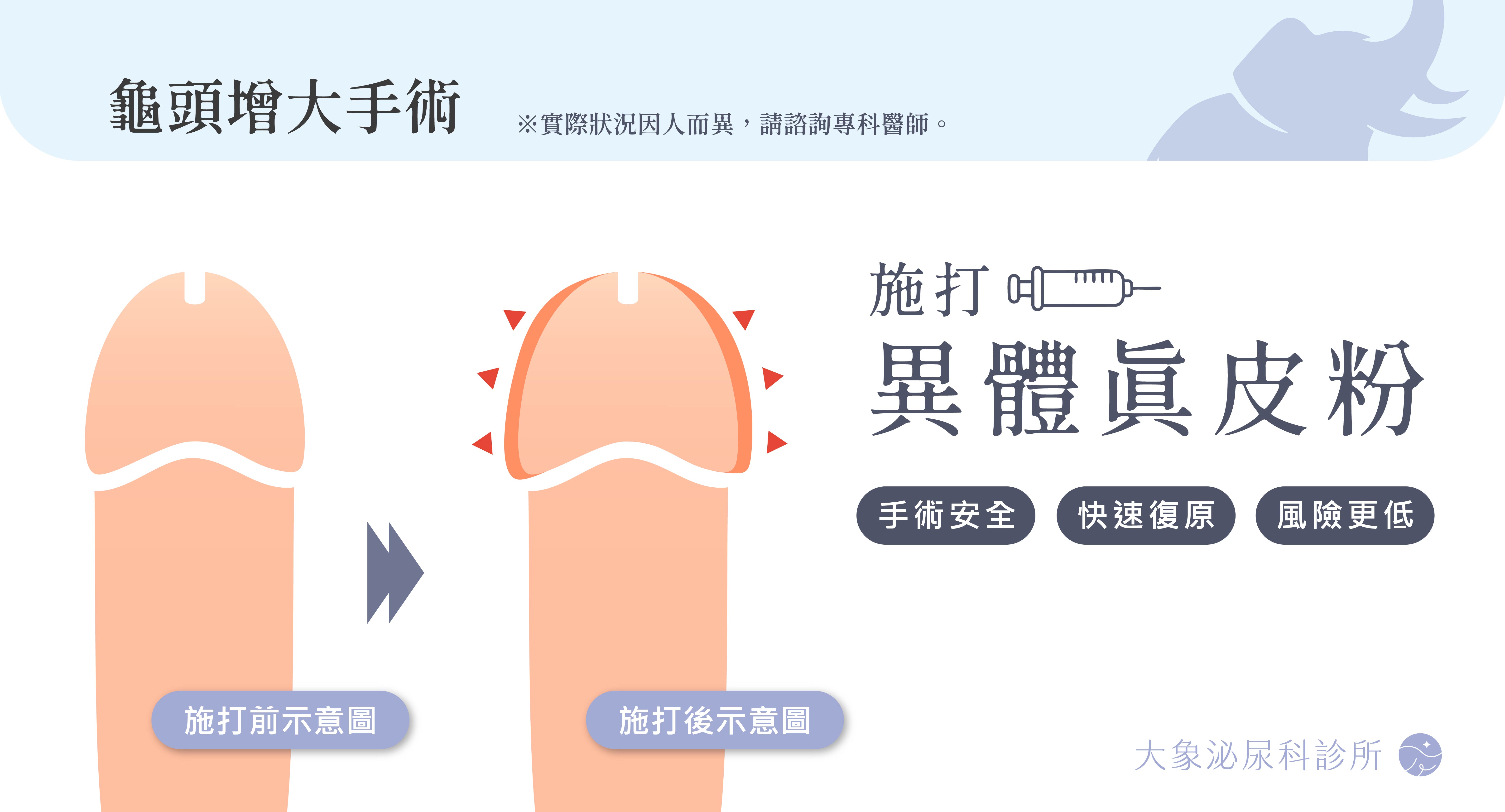 桃園 中壢/泌尿科/大象 - 龜頭增大