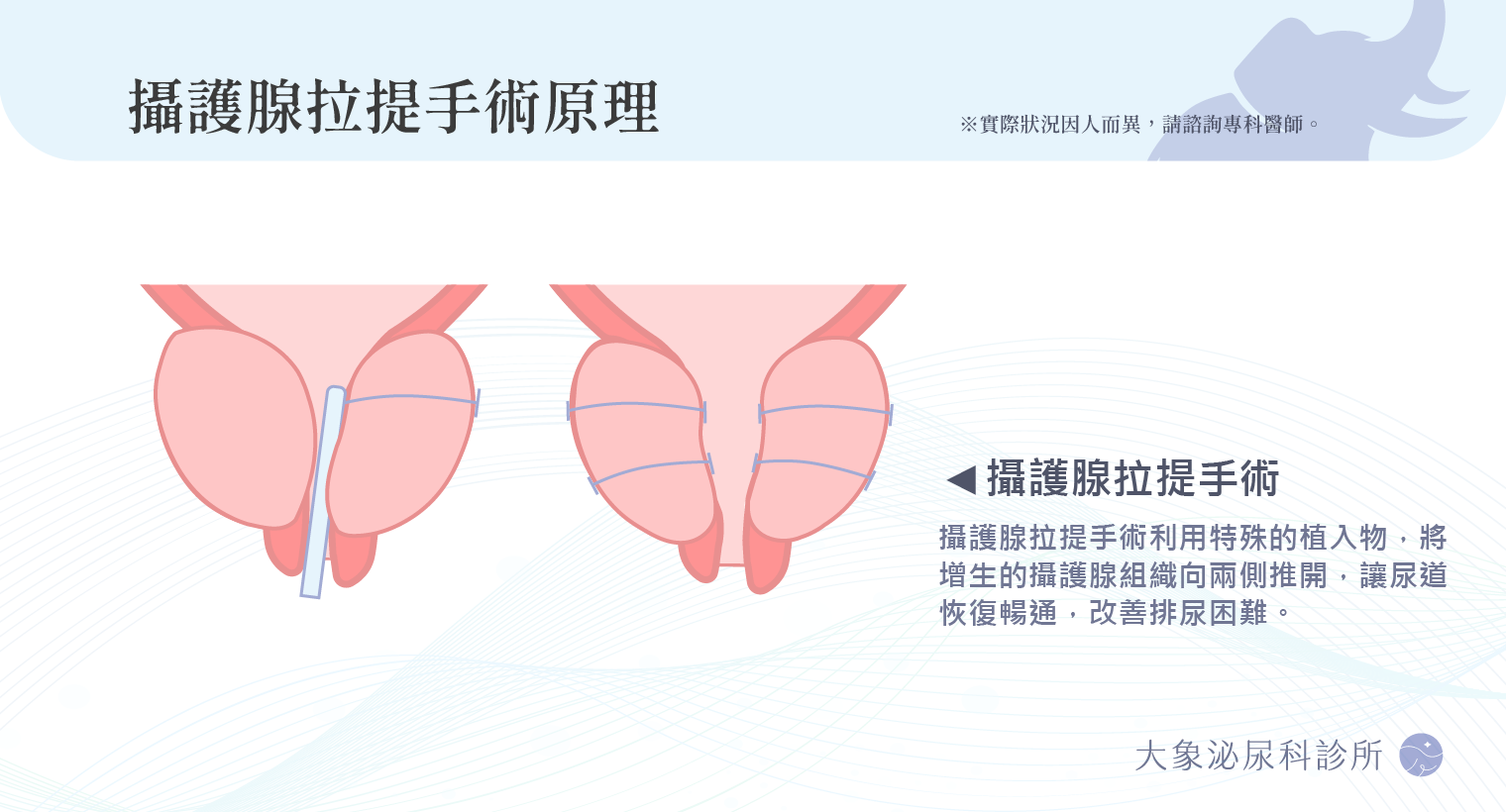 桃園 中壢/泌尿科/大象 - 攝護腺拉提手術
