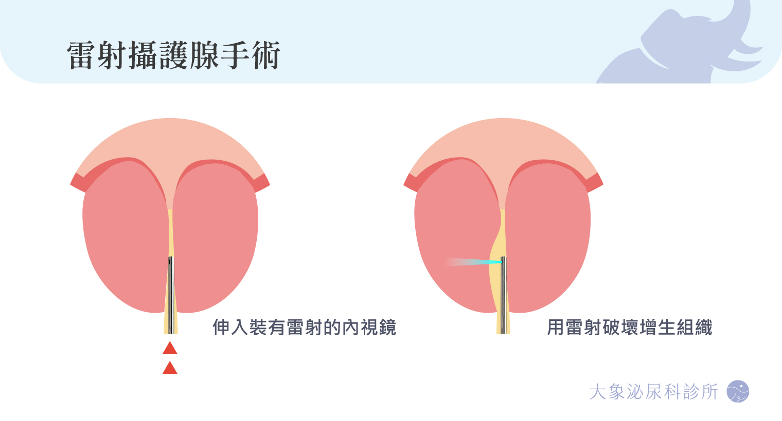 桃園 中壢/泌尿科/大象 - 雷射攝護腺手術